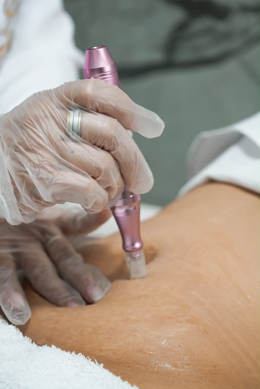 Procedimento corporal realizado pela Dra. Silvaneide